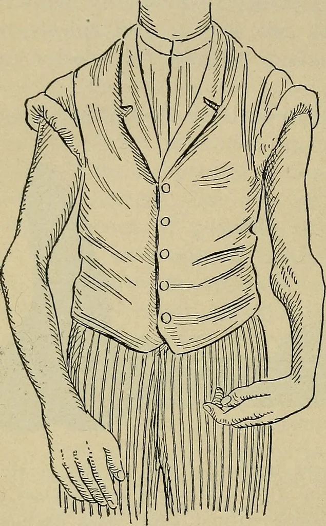 An illustration from Atlas and epitome of traumatic fractures and dislocations / by H. Helferich ; auth. tr. from the German, ed. by Joseph C. Bloodgood., 1902, leaf 88