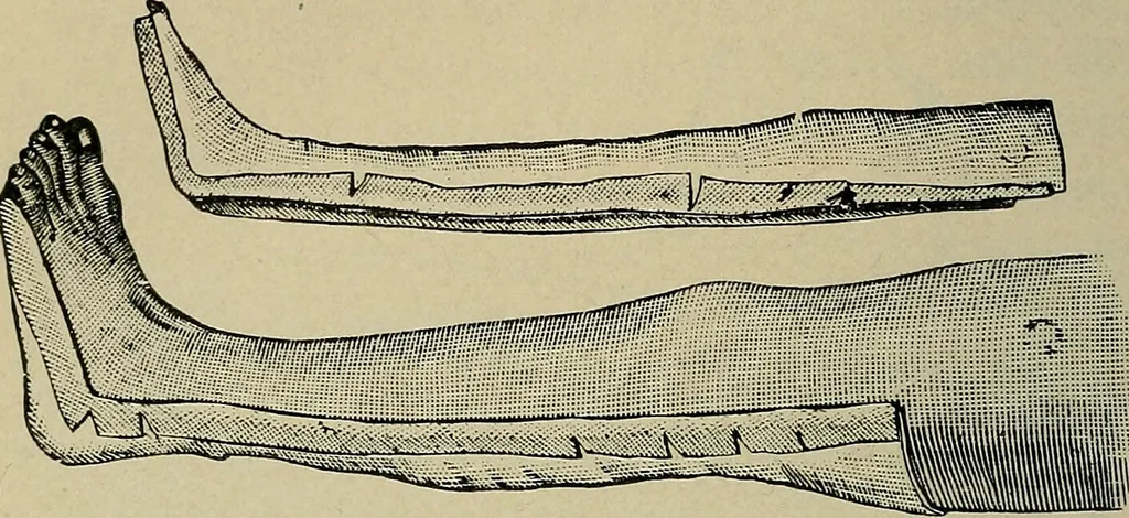 An illustration from Atlas and epitome of traumatic fractures and dislocations / by H. Helferich ; auth. tr. from the German, ed. by Joseph C. Bloodgood., 1902, leaf 92