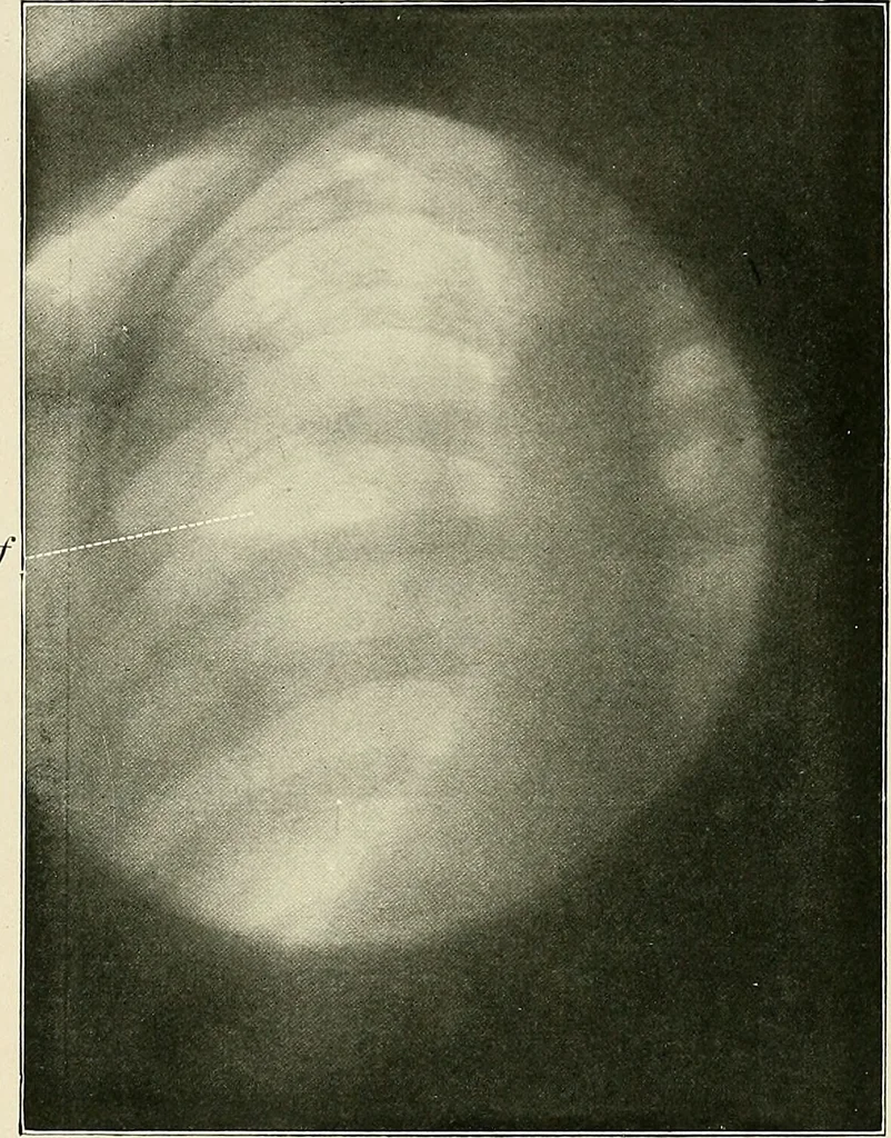 An illustration from Surgery of the lung / by C. Garrè and H. Quincke., 1913, leaf 114