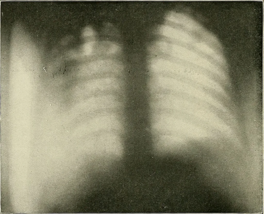 An illustration from Surgery of the lung / by C. Garrè and H. Quincke., 1913, leaf 116