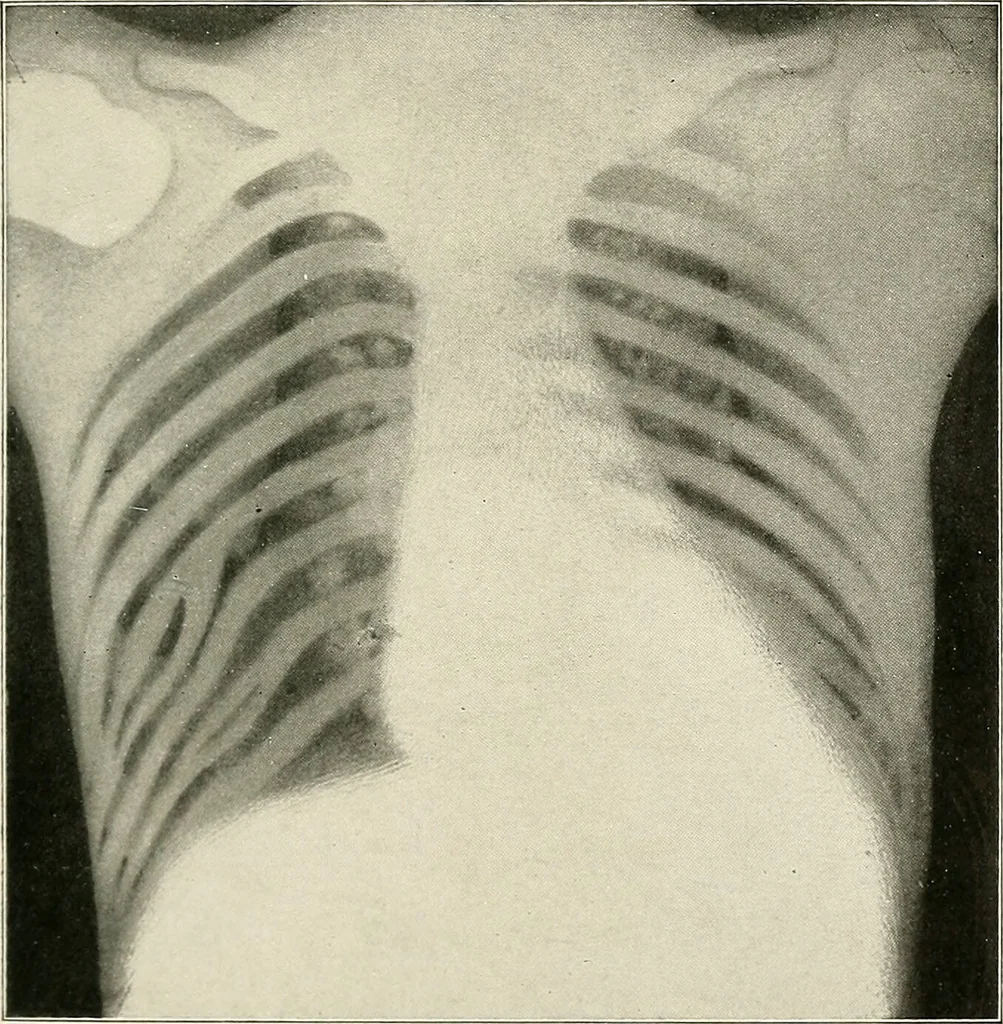 An illustration from Surgery of the lung / by C. Garrè and H. Quincke., 1913, leaf 143