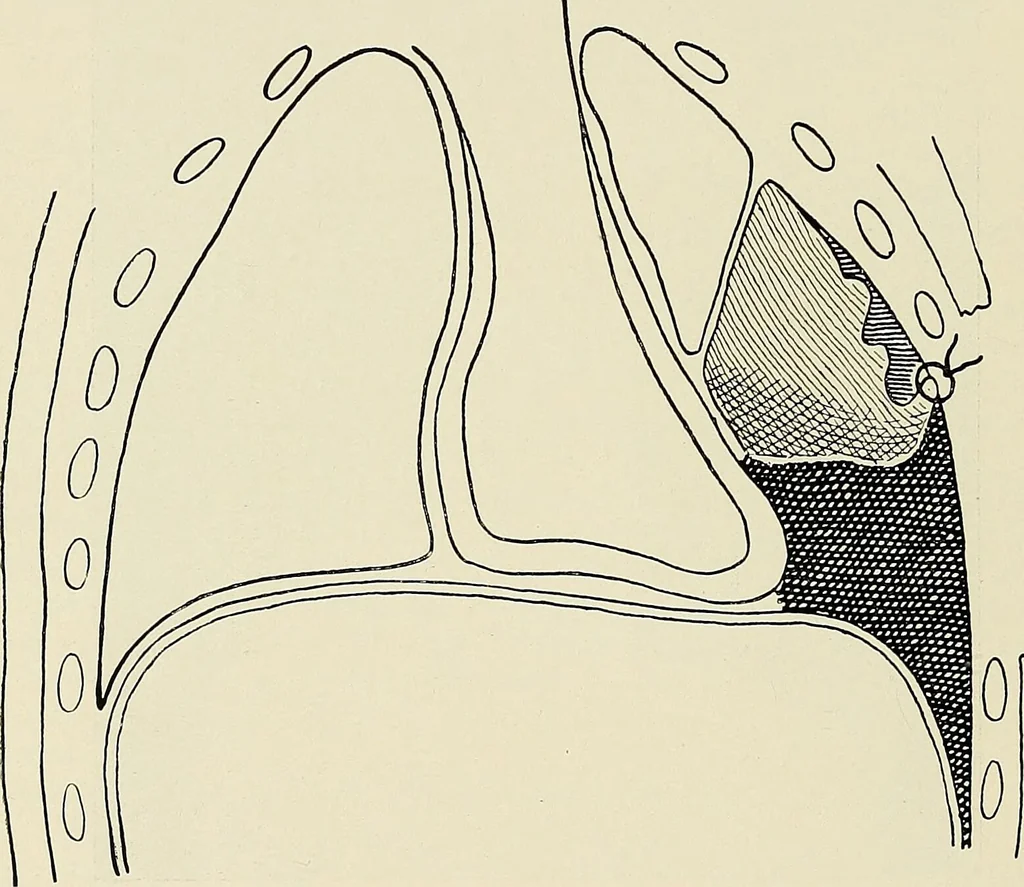 An illustration from Surgery of the lung / by C. Garrè and H. Quincke., 1913, leaf 144
