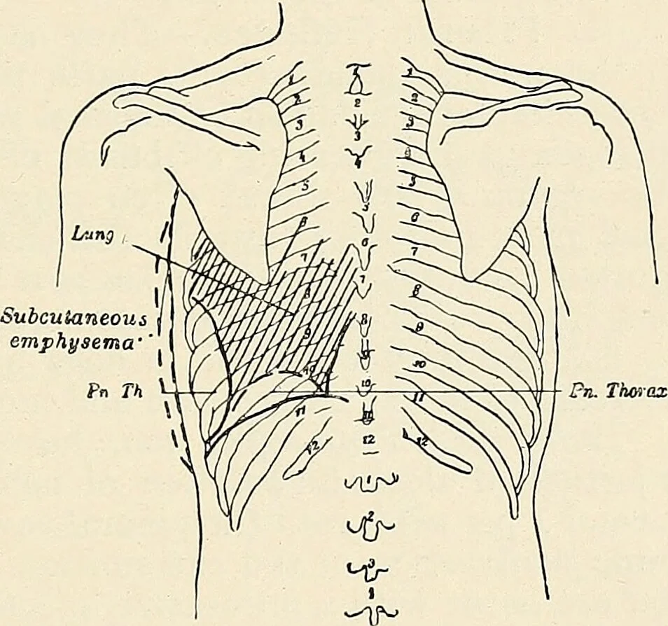 An illustration from Surgery of the lung / by C. Garrè and H. Quincke., 1913, leaf 161