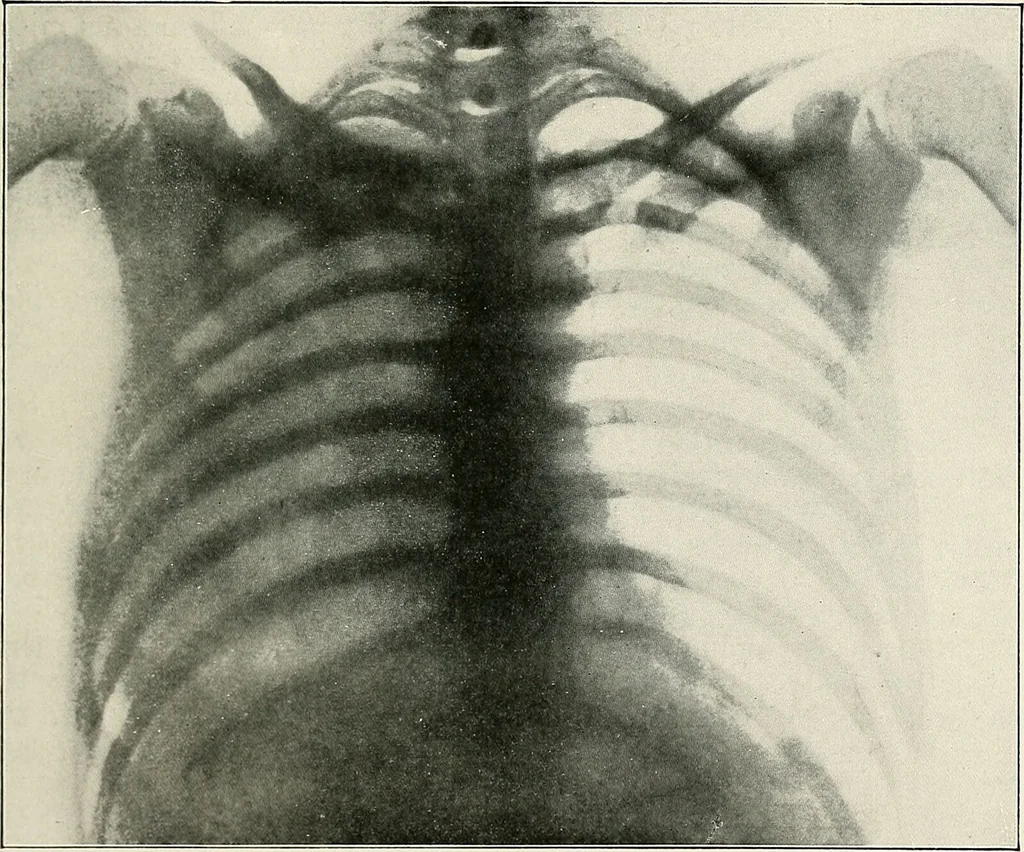An illustration from Surgery of the lung / by C. Garrè and H. Quincke., 1913, leaf 199