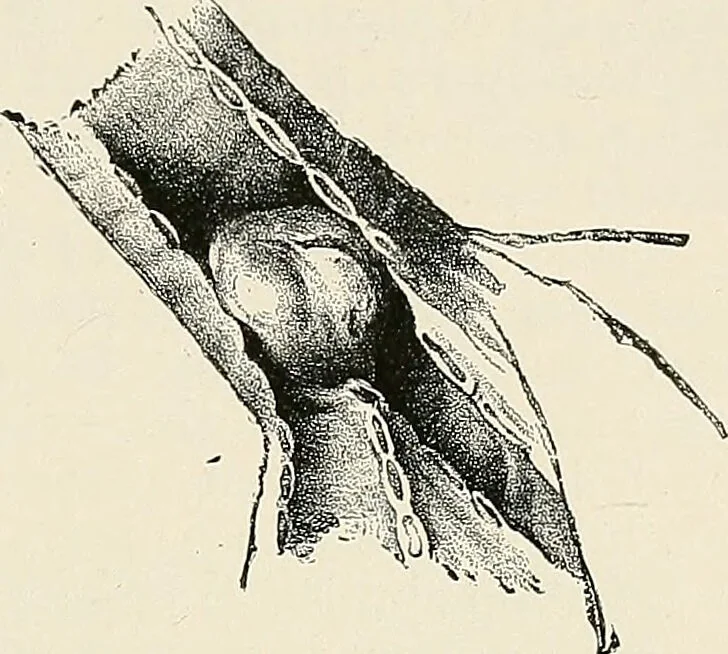 An illustration from Surgery of the lung / by C. Garrè and H. Quincke., 1913, leaf 219