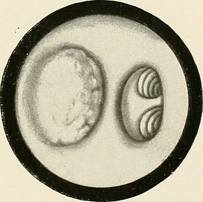 An illustration from Surgery of the lung / by C. Garrè and H. Quincke., 1913, leaf 219