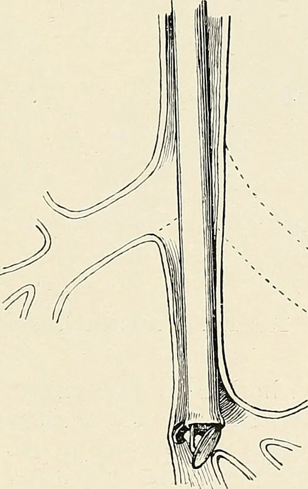 An illustration from Surgery of the lung / by C. Garrè and H. Quincke., 1913, leaf 243