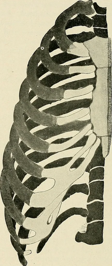 An illustration from Surgery of the lung / by C. Garrè and H. Quincke., 1913, leaf 260