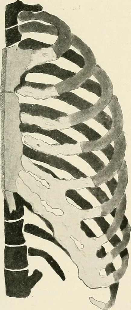 An illustration from Surgery of the lung / by C. Garrè and H. Quincke., 1913, leaf 261