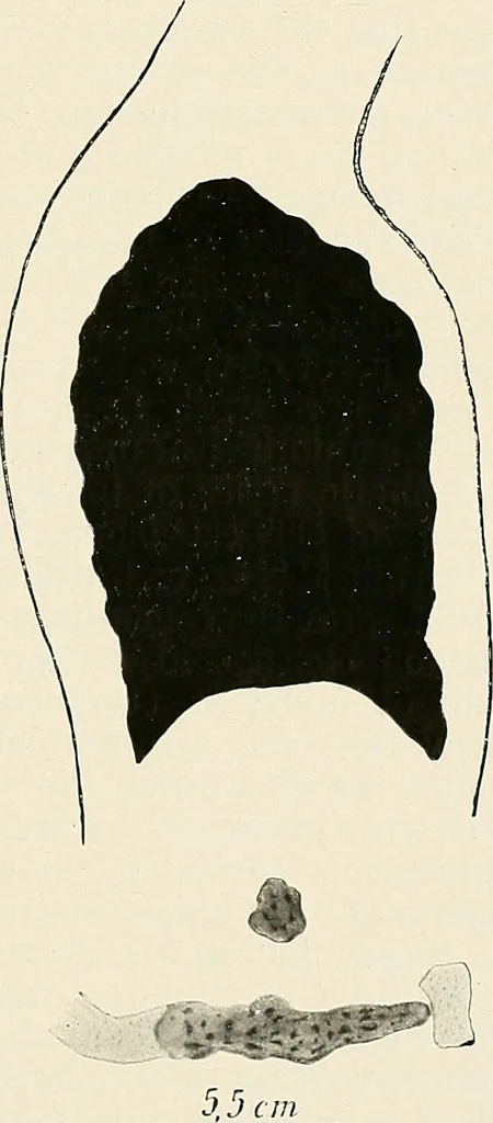 An illustration from Surgery of the lung / by C. Garrè and H. Quincke., 1913, leaf 261