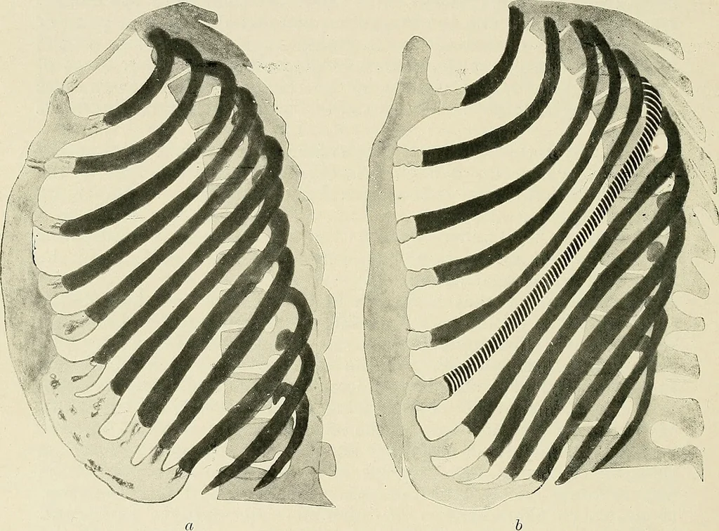 An illustration from Surgery of the lung / by C. Garrè and H. Quincke., 1913, leaf 264
