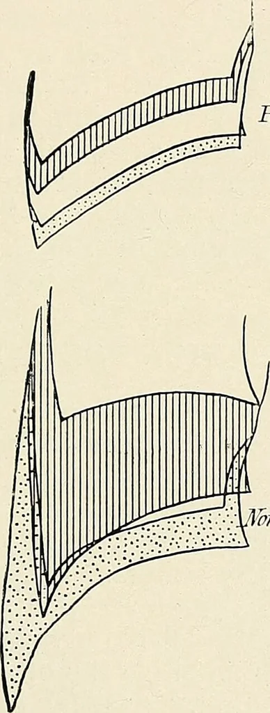 An illustration from Surgery of the lung / by C. Garrè and H. Quincke., 1913, leaf 267