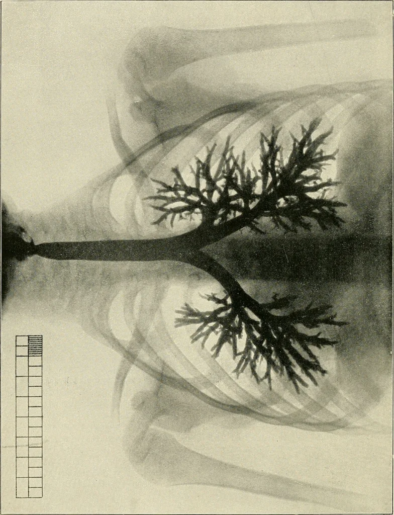 An illustration from Surgery of the lung / by C. Garrè and H. Quincke., 1913, leaf 36