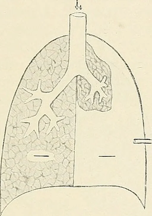 An illustration from Surgery of the lung / by C. Garrè and H. Quincke., 1913, leaf 39