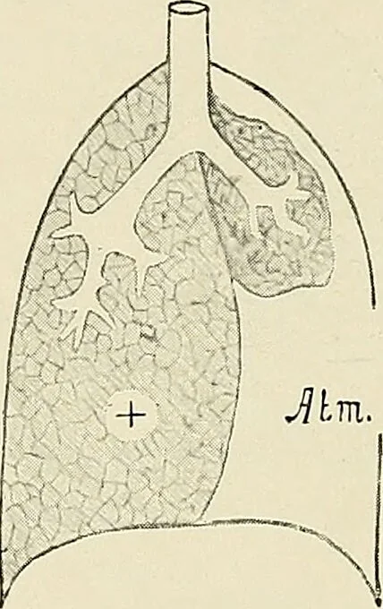 An illustration from Surgery of the lung / by C. Garrè and H. Quincke., 1913, leaf 40