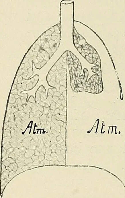 An illustration from Surgery of the lung / by C. Garrè and H. Quincke., 1913, leaf 40