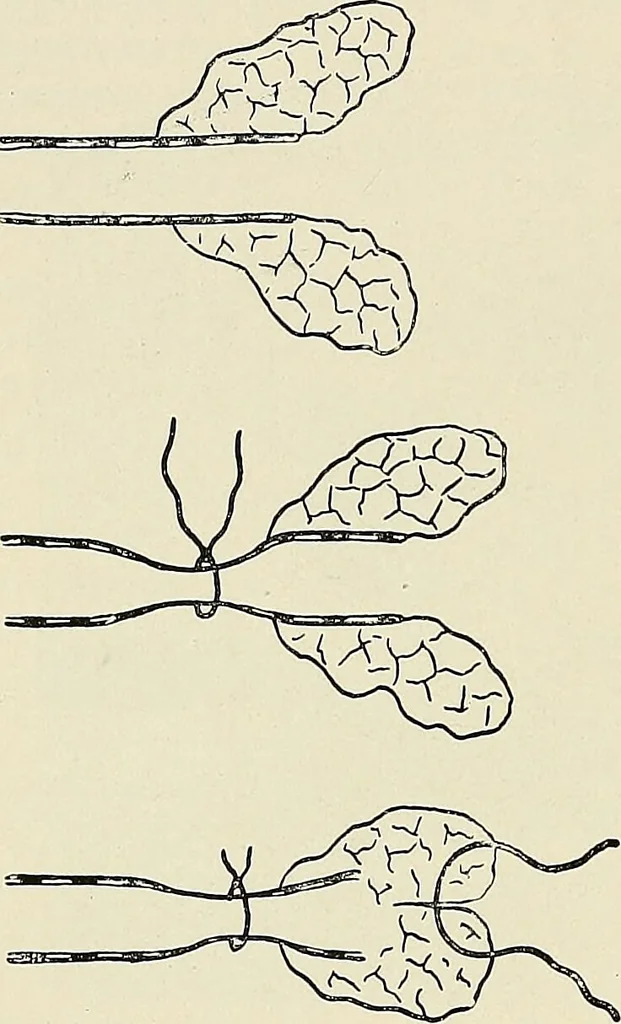 An illustration from Surgery of the lung / by C. Garrè and H. Quincke., 1913, leaf 82