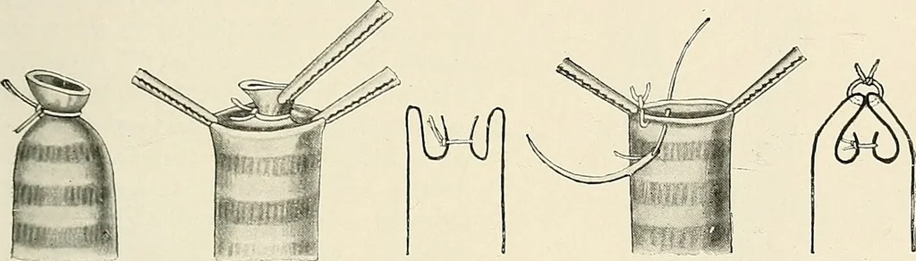 An illustration from Surgery of the lung / by C. Garrè and H. Quincke., 1913, leaf 83