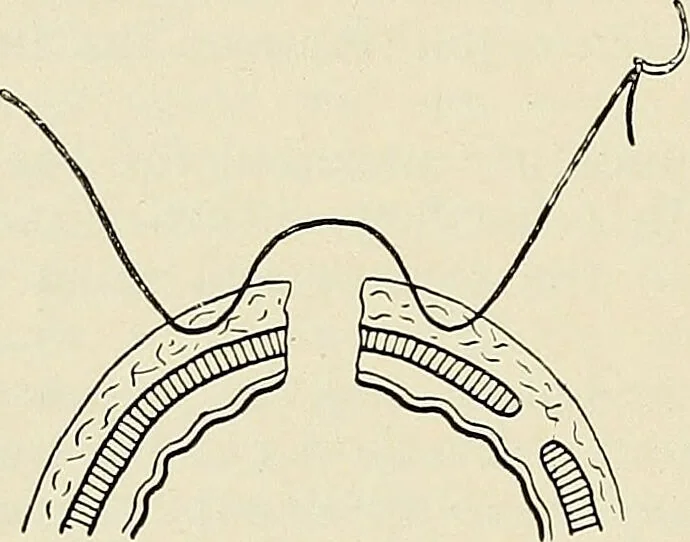 An illustration from Surgery of the lung / by C. Garrè and H. Quincke., 1913, leaf 98