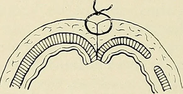 An illustration from Surgery of the lung / by C. Garrè and H. Quincke., 1913, leaf 98