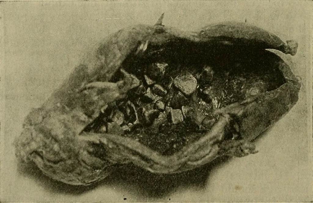 An illustration from Modern surgery, general and operative / by John Chalmers DaCosta., 1914, leaf 1070