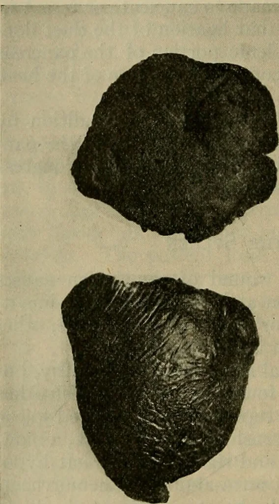 An illustration from Modern surgery, general and operative / by John Chalmers DaCosta., 1914, leaf 1090