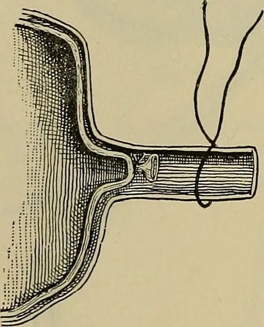 An illustration from Modern surgery, general and operative / by John Chalmers DaCosta., 1914, leaf 1100