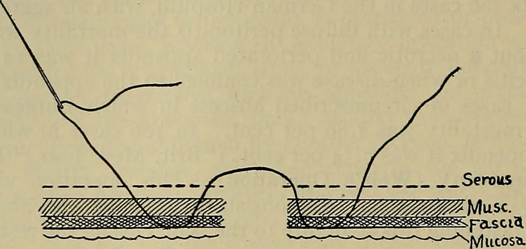 An illustration from Modern surgery, general and operative / by John Chalmers DaCosta., 1914, leaf 1104