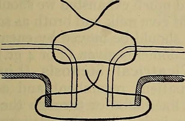 An illustration from Modern surgery, general and operative / by John Chalmers DaCosta., 1914, leaf 1109
