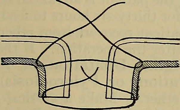 An illustration from Modern surgery, general and operative / by John Chalmers DaCosta., 1914, leaf 1109
