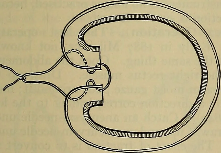 An illustration from Modern surgery, general and operative / by John Chalmers DaCosta., 1914, leaf 1109