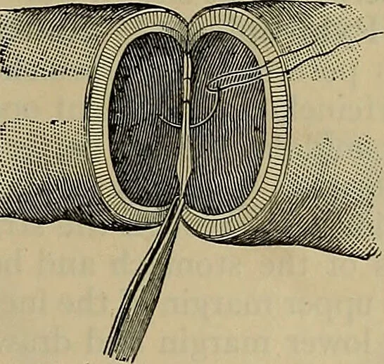 An illustration from Modern surgery, general and operative / by John Chalmers DaCosta., 1914, leaf 1109