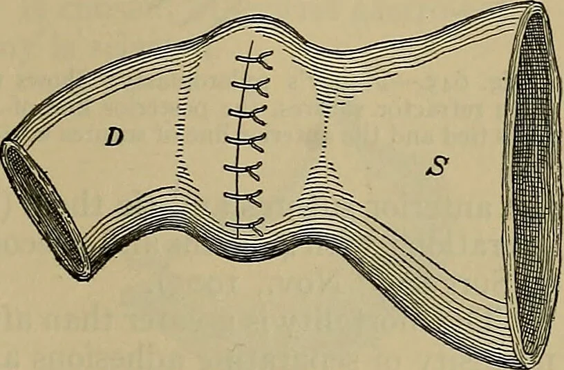An illustration from Modern surgery, general and operative / by John Chalmers DaCosta., 1914, leaf 1111
