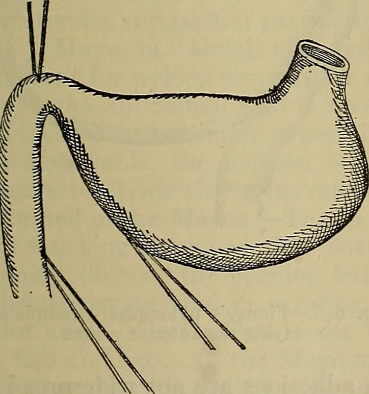 An illustration from Modern surgery, general and operative / by John Chalmers DaCosta., 1914, leaf 1111