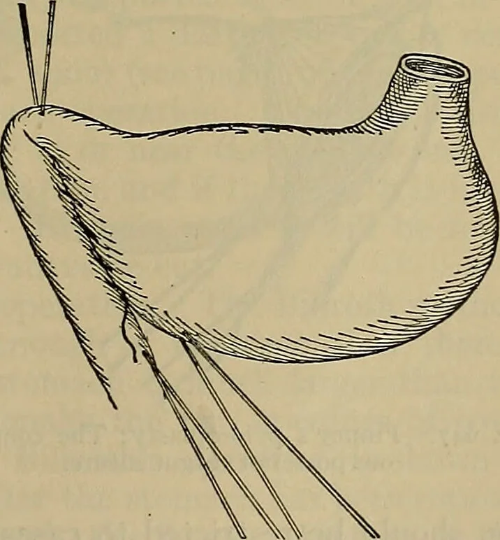 An illustration from Modern surgery, general and operative / by John Chalmers DaCosta., 1914, leaf 1111