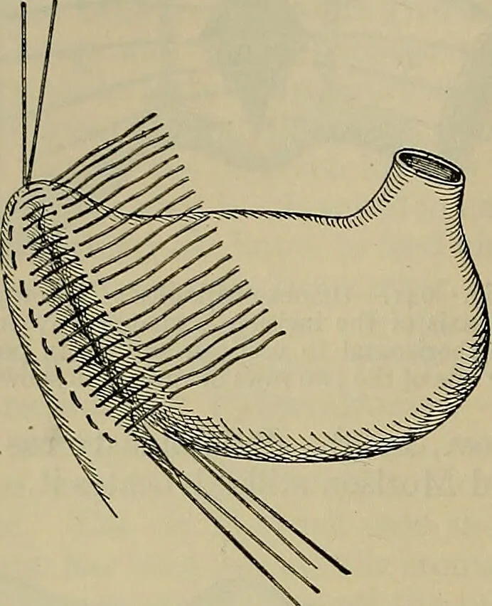 An illustration from Modern surgery, general and operative / by John Chalmers DaCosta., 1914, leaf 1112