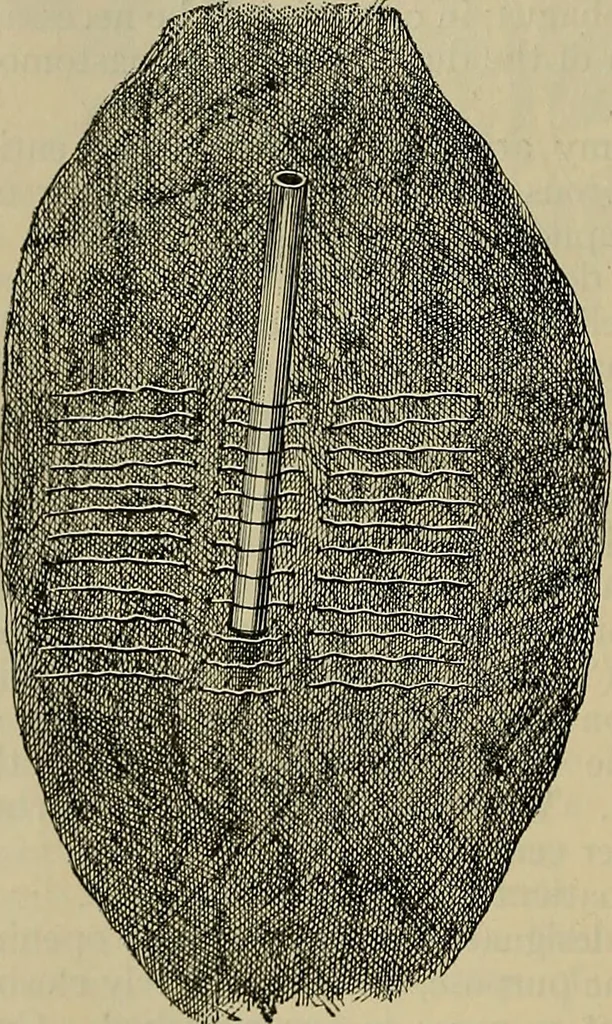 An illustration from Modern surgery, general and operative / by John Chalmers DaCosta., 1914, leaf 1116