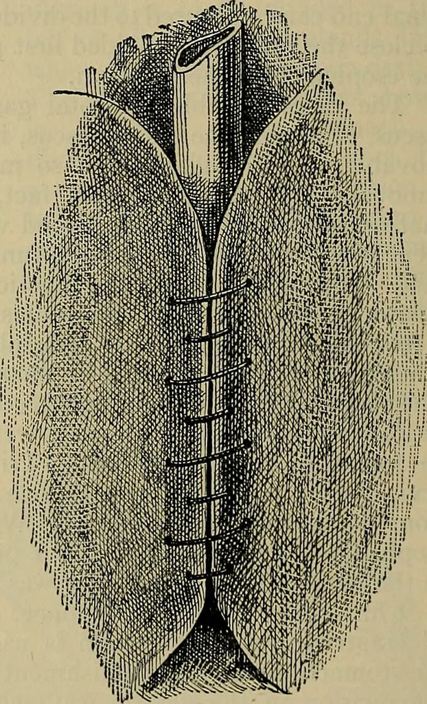 An illustration from Modern surgery, general and operative / by John Chalmers DaCosta., 1914, leaf 1116