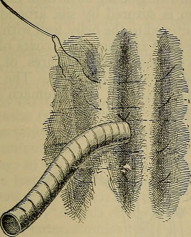 An illustration from Modern surgery, general and operative / by John Chalmers DaCosta., 1914, leaf 1117