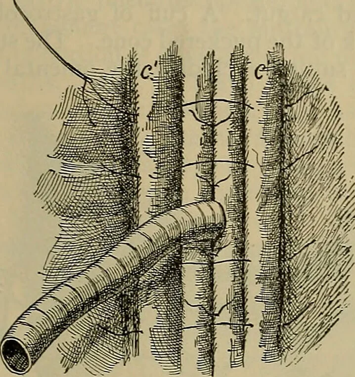 An illustration from Modern surgery, general and operative / by John Chalmers DaCosta., 1914, leaf 1117