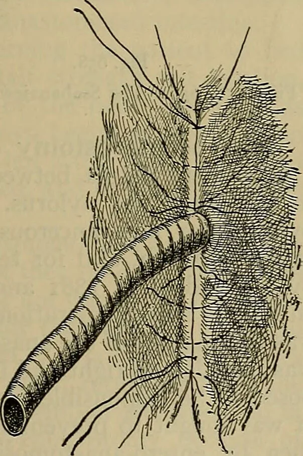 An illustration from Modern surgery, general and operative / by John Chalmers DaCosta., 1914, leaf 1117