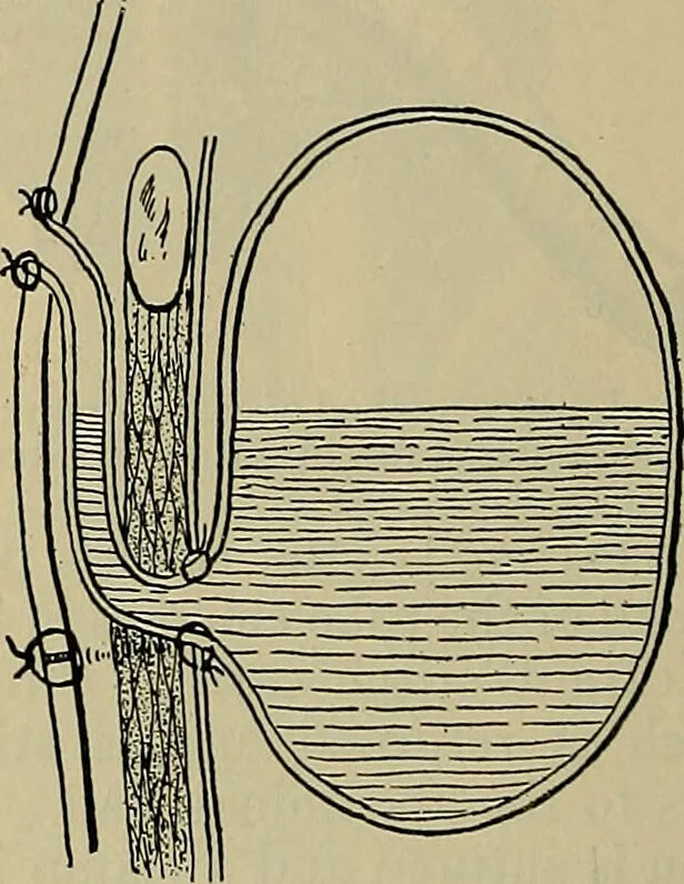 An illustration from Modern surgery, general and operative / by John Chalmers DaCosta., 1914, leaf 1118