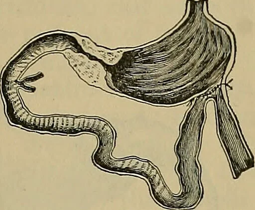 An illustration from Modern surgery, general and operative / by John Chalmers DaCosta., 1914, leaf 1121