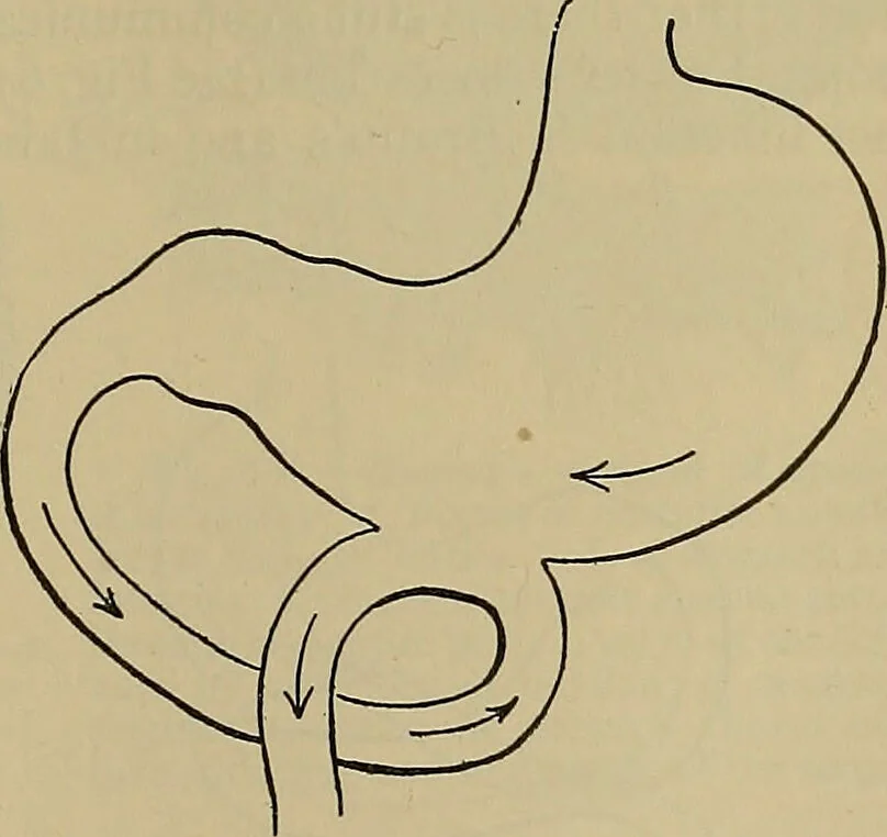 An illustration from Modern surgery, general and operative / by John Chalmers DaCosta., 1914, leaf 1121