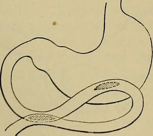 An illustration from Modern surgery, general and operative / by John Chalmers DaCosta., 1914, leaf 1122