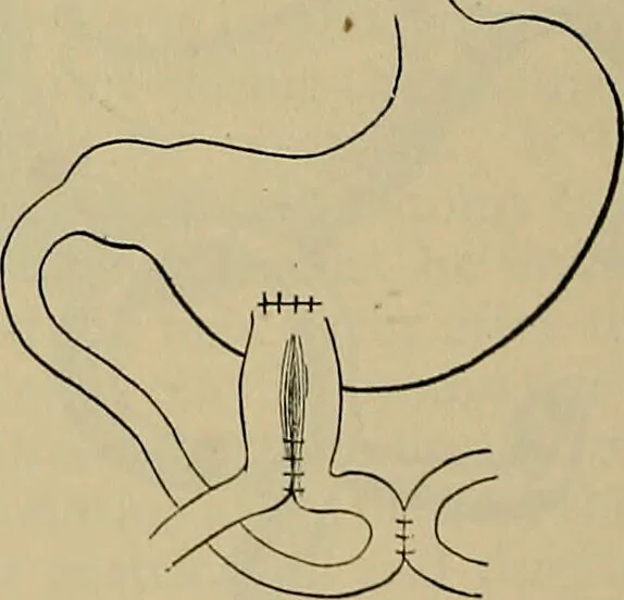 An illustration from Modern surgery, general and operative / by John Chalmers DaCosta., 1914, leaf 1122