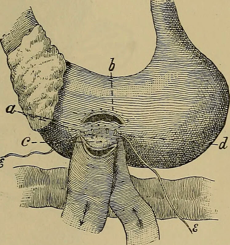 An illustration from Modern surgery, general and operative / by John Chalmers DaCosta., 1914, leaf 1123