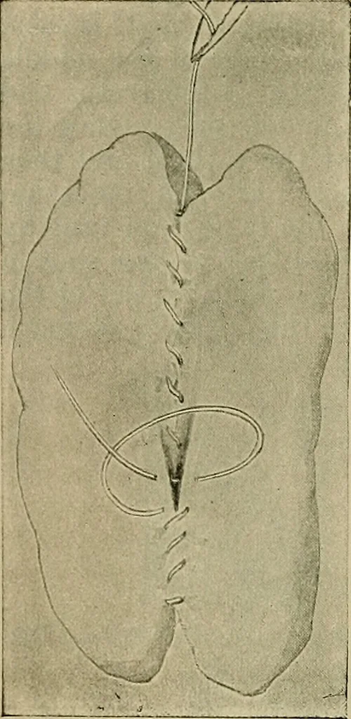 An illustration from Modern surgery, general and operative / by John Chalmers DaCosta., 1914, leaf 1130