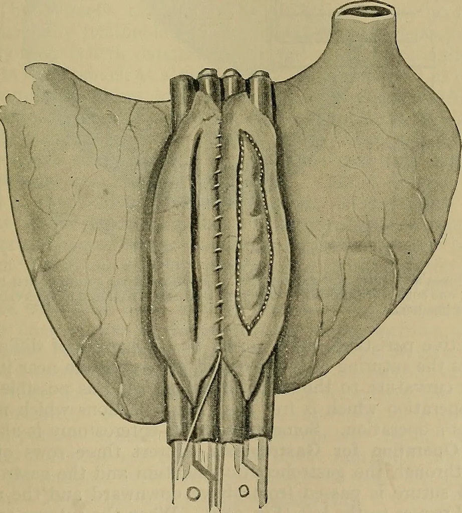 An illustration from Modern surgery, general and operative / by John Chalmers DaCosta., 1914, leaf 1133