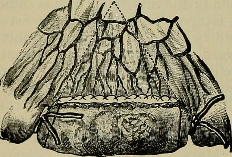 An illustration from Modern surgery, general and operative / by John Chalmers DaCosta., 1914, leaf 1136